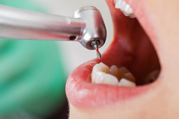 Best Emergency Tooth Extraction in Wolfdale, PA